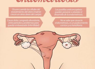 Endometriosis