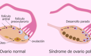 Ovario poliquistico